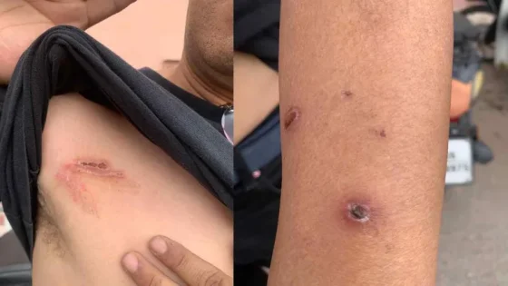كلب حراسة يعتدي على مواطن بمراكش ويتسبب له في إصابات متفاوتة الخطورة
