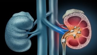 وداعا لجراحة حصى الكلى؟