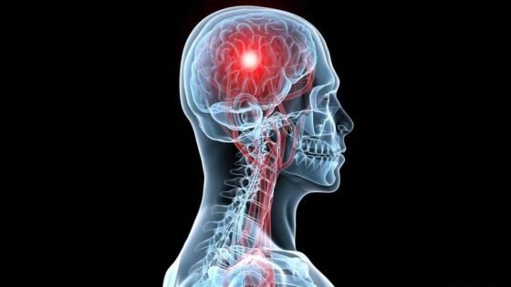 وزارة الصحة تطلق حملة وطنية للتحسيس حول الوقاية من السكتة الدماغية