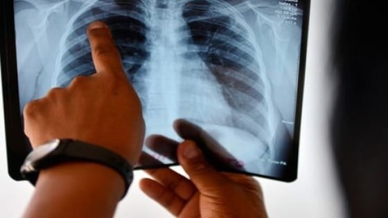 السل يتجاوز الرئتين في المغرب: 53% من الحالات خارج الرئة ووزارة الصحة تدق ناقوس التوعية